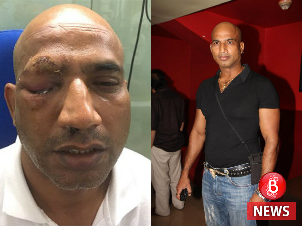 Jeetu Verma struggles for eyesight after getting severely injured by highway robbers