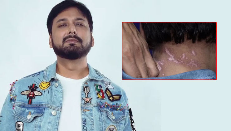 'Bigg Boss 13': Eliminated contestant Siddhartha Dey shows his horrific bleach wounds