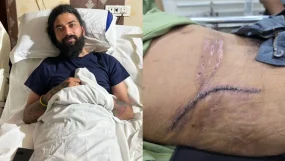 Bigg Boss 17 Fame Anurag Dobhal Gives Glimpse Of Injury Scars From Accident