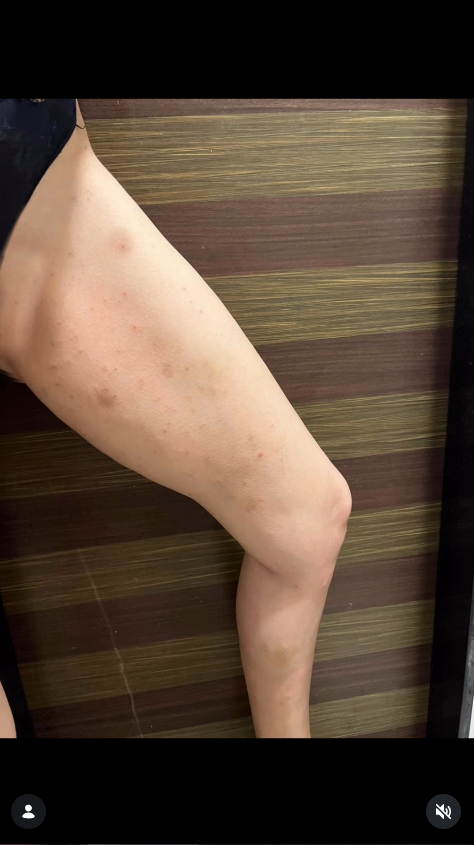 Sonali Raut Shows Severe Conditions On Her Leg